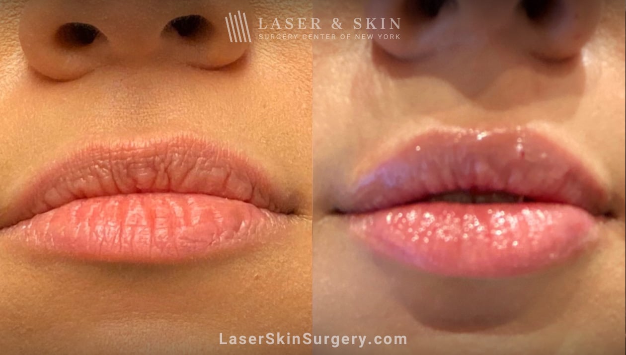 Filler-for-plumping-symmetry-lips-LSSC-NYC thin lips treatment results
