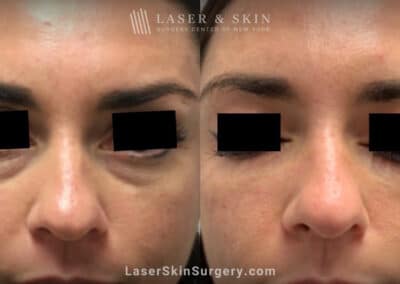 Filler Injections Under the Eye to Treat Discoloration