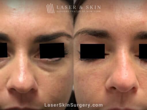 Filler Injections Under the Eye to Treat Discoloration