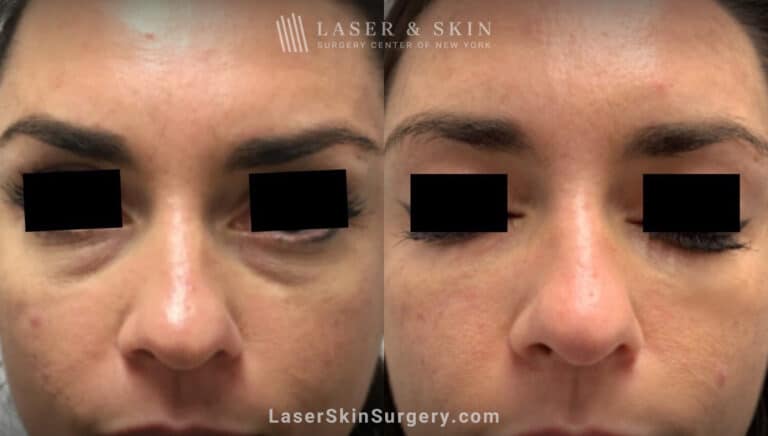 Filler Injections Under the Eye to Treat Discoloration