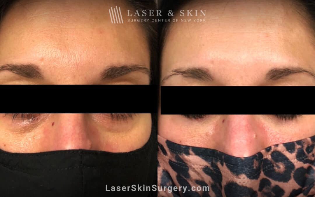 Filler Injections Under the Eye to Add Volume