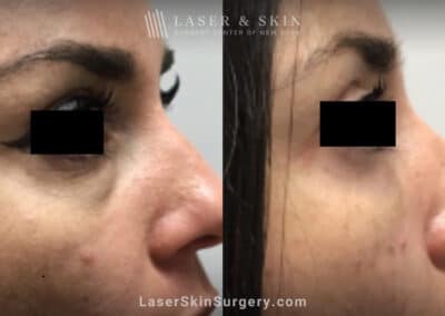 Filler Injections Under the Eye to Treat Discoloration