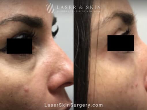 Filler Injections Under the Eye to Treat Discoloration