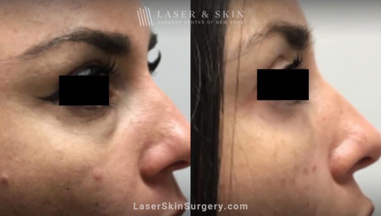 Filler Injections Under the Eye to Treat Discoloration