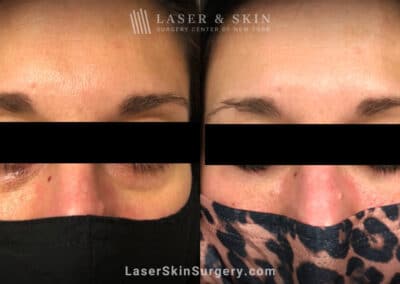 Filler Injections Under the Eye to Add Volume