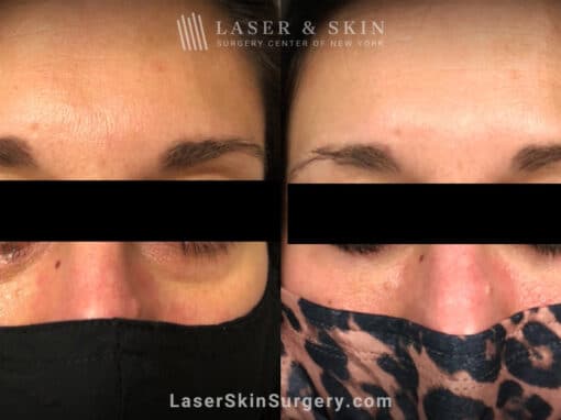 Filler Injections Under the Eye to Add Volume