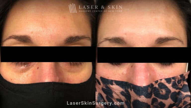 Filler Injections Under the Eye to Add Volume