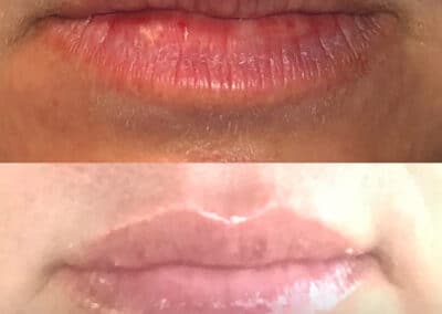 Filler Injections to Add Volume to Lips