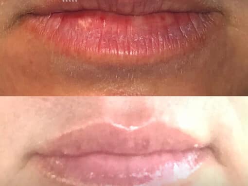 Filler Injections to Add Volume to Lips