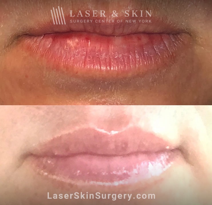 Filler Injections to Add Volume to Lips