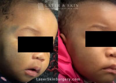 Laser treatment for nevus of ota birthmark