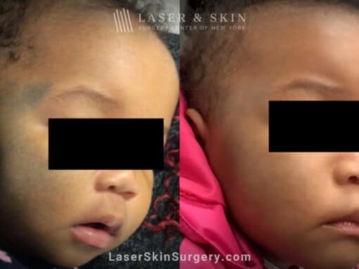 Laser treatment for nevus of ota birthmark