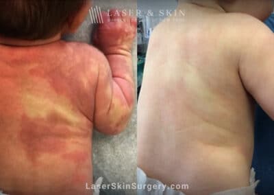 Laser treatment for port wine birthmark on infant’s back