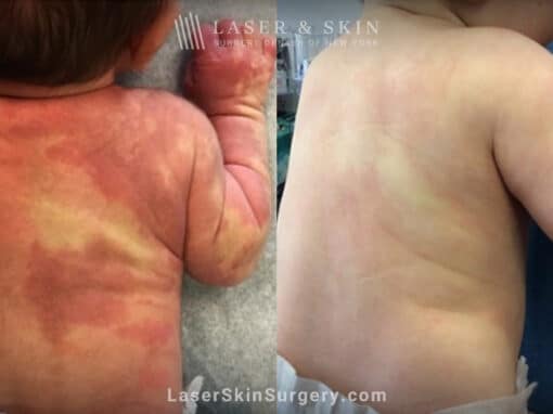 Laser treatment for port wine birthmark on infant’s back