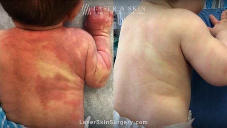 Laser treatment for port wine birthmark on infant’s back