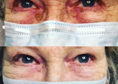 Laser treatment to remove lesion under the eye