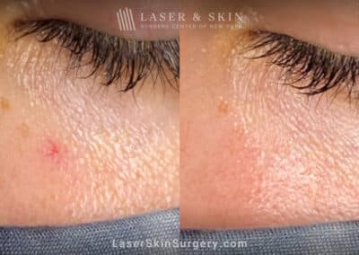 Laser treatment to remove red mark under the eye