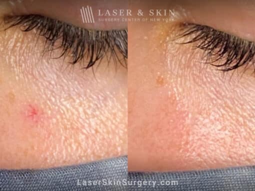 Laser treatment to remove red mark under the eye