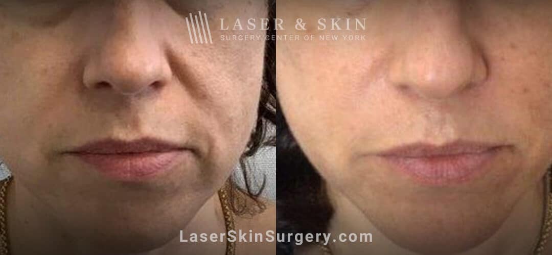 Laser treatment for nasolabial folds