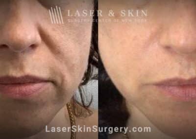 Laser treatment for nasolabial folds