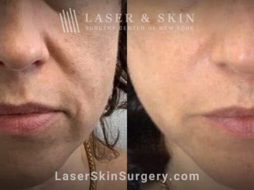 Laser treatment for nasolabial folds