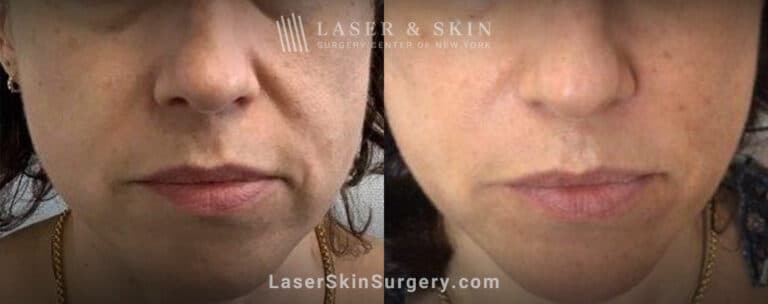 Laser treatment for nasolabial folds