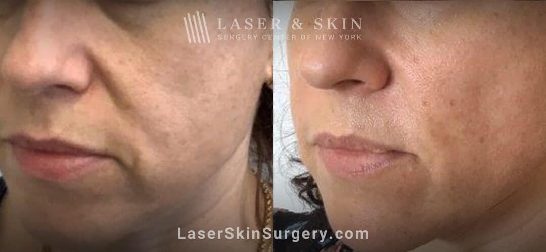 Laser treatment for nasolabial folds