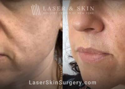Laser treatment for nasolabial folds