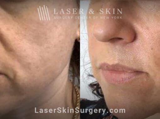 Laser treatment for nasolabial folds