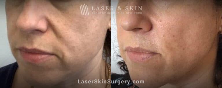 Laser treatment for nasolabial folds