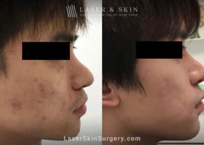 Laser treatment for active acne