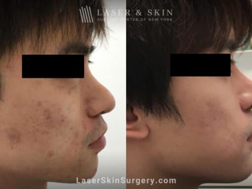 Laser treatment for active acne