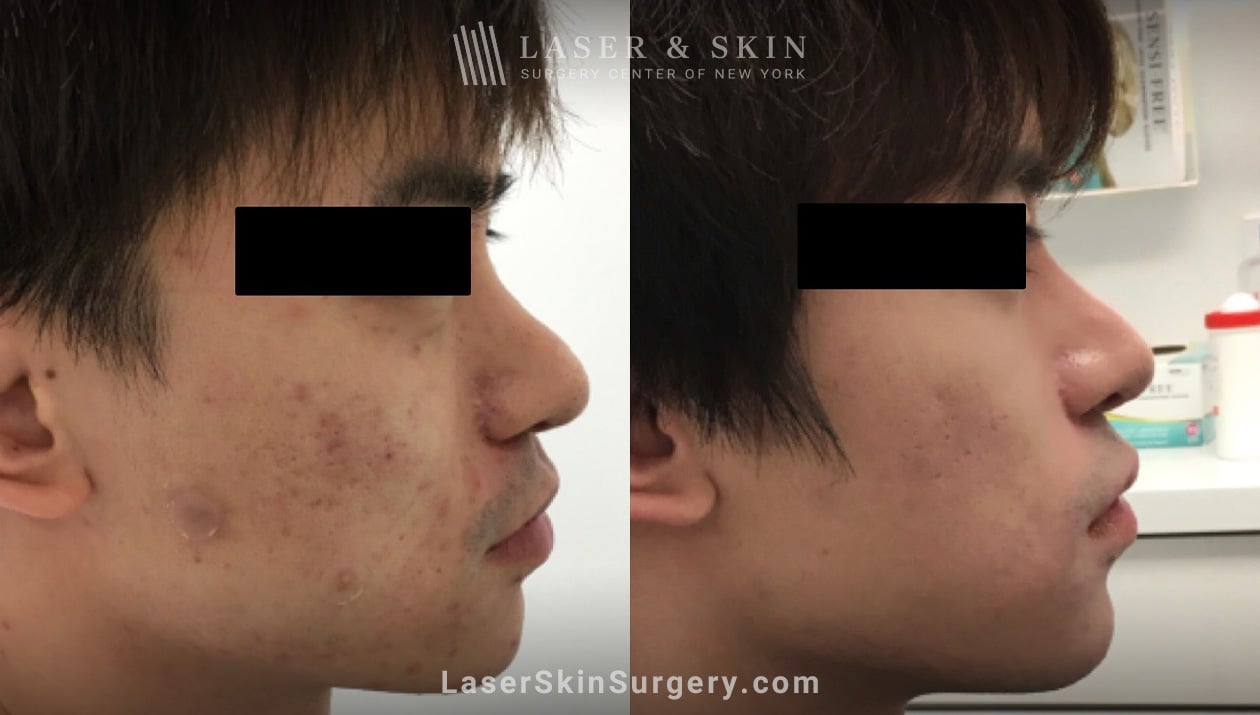 lsscny cosmetic laser treatment for acne before and after NYC, NY