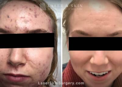 Laser treatment for active acne
