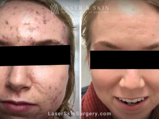 Laser treatment for active acne