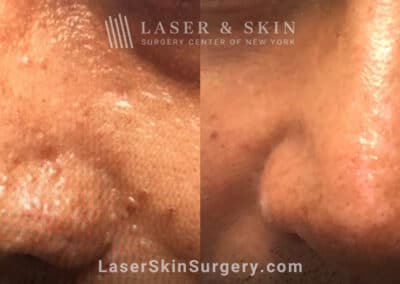 Laser treatment to smooth skin on nose