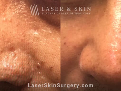 Laser treatment to smooth skin on nose