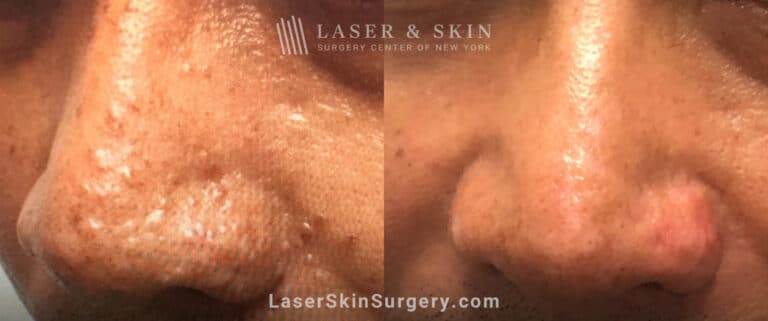 Laser treatment to smooth skin on nose