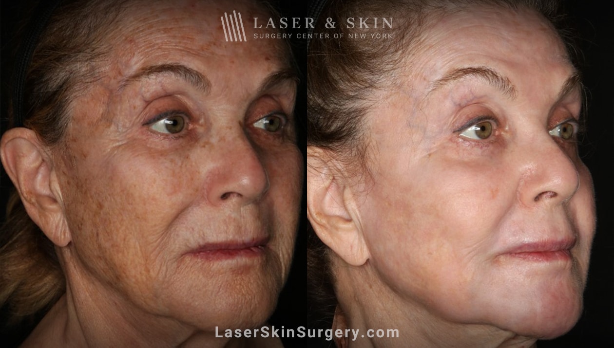Laser-treatment-sun-damage-brown-spots-wrinkles-LSSC-NYC brown spots removal in new york