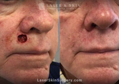 Mohs surgery to treat skin cancer above upper lip