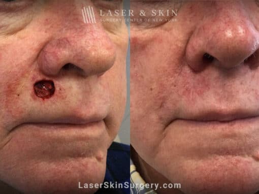 Mohs surgery to treat skin cancer above upper lip