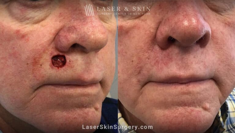 Mohs surgery to treat skin cancer above upper lip