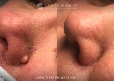 Mole removal to remove lesion from nose