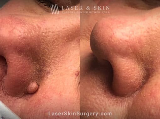 Mole removal to remove lesion from nose