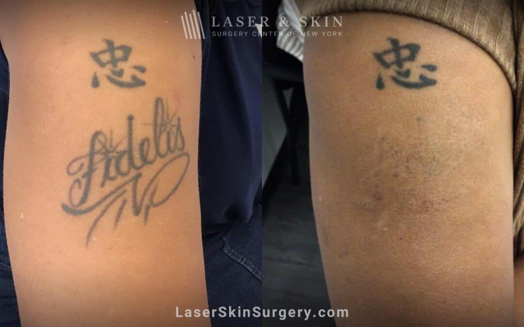 PicoPlus laser to remove unwanted tattoo