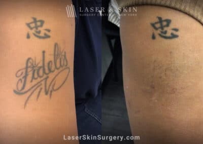 PicoPlus laser to remove unwanted tattoo