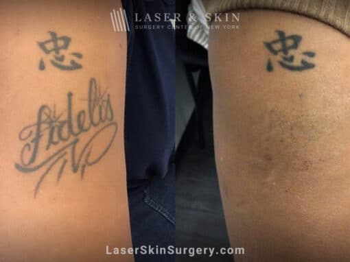 PicoPlus laser to remove unwanted tattoo