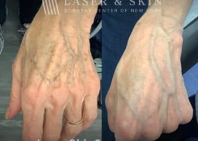Ruby laser to treat lentigines and sun damage on hand