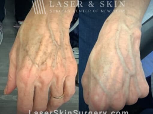 Ruby laser to treat lentigines and sun damage on hand