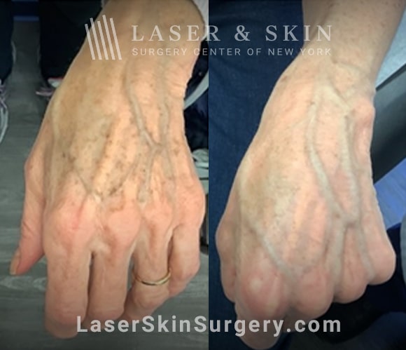 Ruby laser to treat lentigines and sun damage on hand